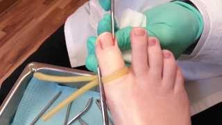 Ingrown toenail surgery [upl. by Condon]