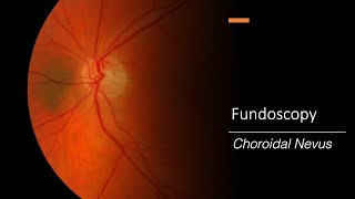 Choroidal Nevus Fundoscopy [upl. by Healey149]