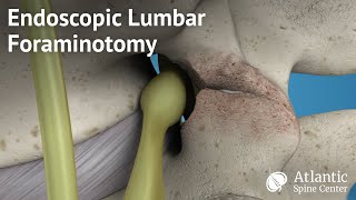 Endoscopic Lumbar Foraminotomy [upl. by Arammahs953]