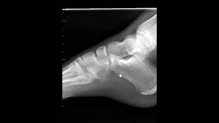 Ankle Fracture Series Management Technique for Lateral Malleolar Fractures  GAITS Academy [upl. by Curren]