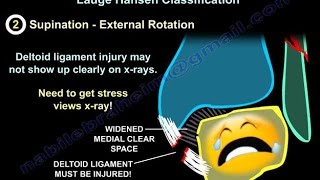 Treatment of Common Geriatric Fractures Spine and Pelvis [upl. by Ratib]