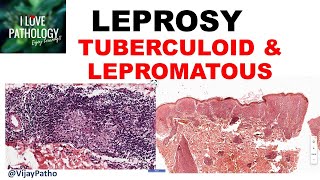 LEPROSY etiopathogenesis classification Tuberculoid amp lepromatous leprosy [upl. by Doloritas]