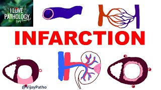 INFARCTION Causes Types Morphology [upl. by Portia]