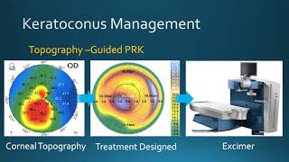 Collagen Cross Linking For keratoconus [upl. by Llener713]