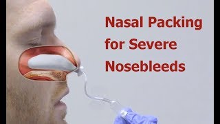 Nasal Packing for Severe Nosebleeds [upl. by Ladnyk89]