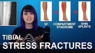 Tibial Stress Fractures Cause Treatment Comparisons [upl. by Ysor]