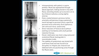 Closed Reduction of 5th Metacarpal Fracture [upl. by Hennie]