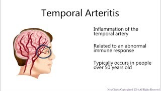 Temporal arteritis [upl. by Adnerb]