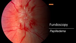 Papilledema Fundoscopy [upl. by Aubert]