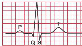 Normal EKG vs Heart Attack [upl. by Aivilo]