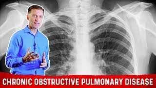 Intermittent Fasting and Chronic Obstructive Pulmonary Disease COPD – DrBerg [upl. by Samara]