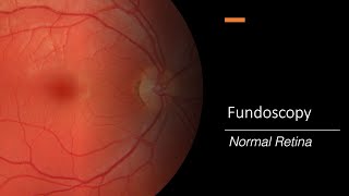 Healthy Retina Fundoscopy [upl. by Evan939]