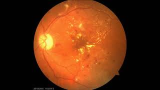 Fundoscopic images of Diabetic Retinopathy [upl. by Amick]