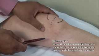 Knee Injection  Medial Approach [upl. by Jasper487]