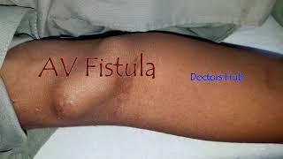 Fistula for Dialysis  Dialysis Access  AV Fistula [upl. by Kcirdderf229]