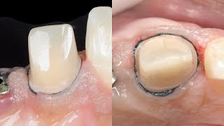 Dental basics Gingival Retraction  The two cord technique [upl. by Ecilahc]