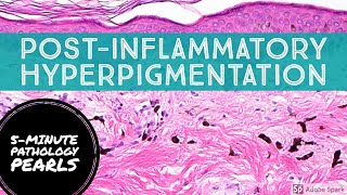 PostInflammatory Hyperpigmentation Pigment Incontinence 5Minute Pathology Pearls [upl. by Selim]