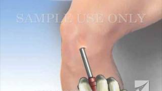 Knee Arthroscopy [upl. by Ihcas867]