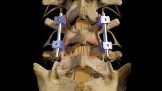 L45 Posterior Interbody Fusion [upl. by Ogdon703]