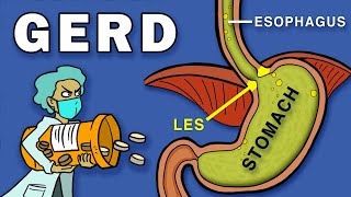 Gastroesophageal Reflux Disease GERD [upl. by Nahtad]