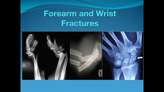 Forearm and Wrist fractures [upl. by Sulokcin]