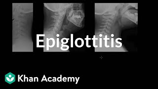 Epiglottitis diagnosis and treatment  Respiratory system diseases  NCLEXRN  Khan Academy [upl. by Carmelle]