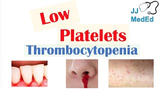 Thrombocytopenia  Signs and Symptoms and Approach to Causes [upl. by Loydie]