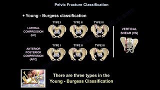 The Impact of Vertebral Compression Fractures [upl. by Irrep]