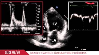 Acute Myocardial Infarction [upl. by Lars]