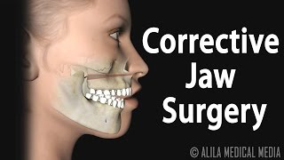 Stapedotomy surgery for Otosclerosis [upl. by Sontich222]