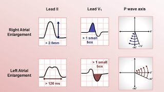 Myocardial Infarction  STEMI on ECG  Practice EKG [upl. by Dymphia726]