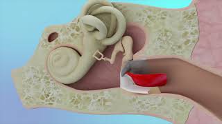 Eardrum Hole Repair Animation [upl. by Ahsikyw]