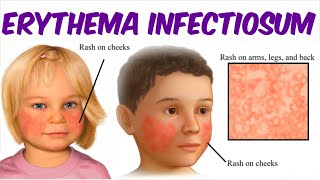 Erythema Infectiosum Fifth Disease [upl. by Ahsiruam184]