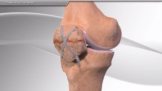 Patella Fracture Repair [upl. by Eliseo]