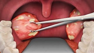 TONSIL REMOVAL SURGERY  Tonsillectomy Surgery [upl. by Trebornhoj788]