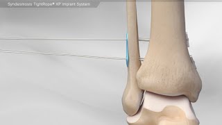 Syndesmosis TightRope® XP Implant System [upl. by Ryder]