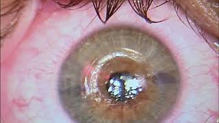 Keratoconus and C3R Corneal Cross Linking Treatment In Hindi [upl. by Ray]