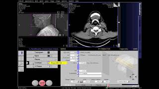 How to Read the CT Scans  How to Read CT Myelograms  How to Read Spine Imaging [upl. by Bonn]