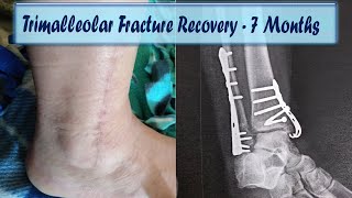 Trimalleolar Fracture Recovery  7 Months [upl. by Einnol581]