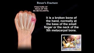 Boxers Fracture  Everything You Need To Know  Dr Nabil Ebraheim [upl. by Akcirre61]