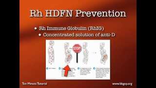 Dosing Rh Immune Globulin [upl. by Ulyram]