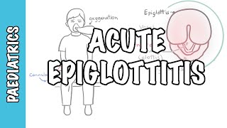 Acute Epiglottitis  signs and symptoms causes pathophysiology treatment [upl. by Gnihc]