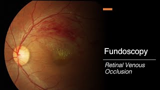 Retinal Venous Occlusion Fundoscopy [upl. by Goldenberg]