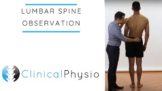 Lumbar Spine Observation  Clinical Physio [upl. by Ytrebil]