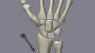 Scaphoid Fractures [upl. by Wylie]